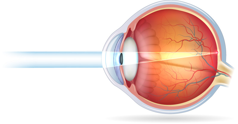 Visione normale dopo intervento di chirurgia refrattiva